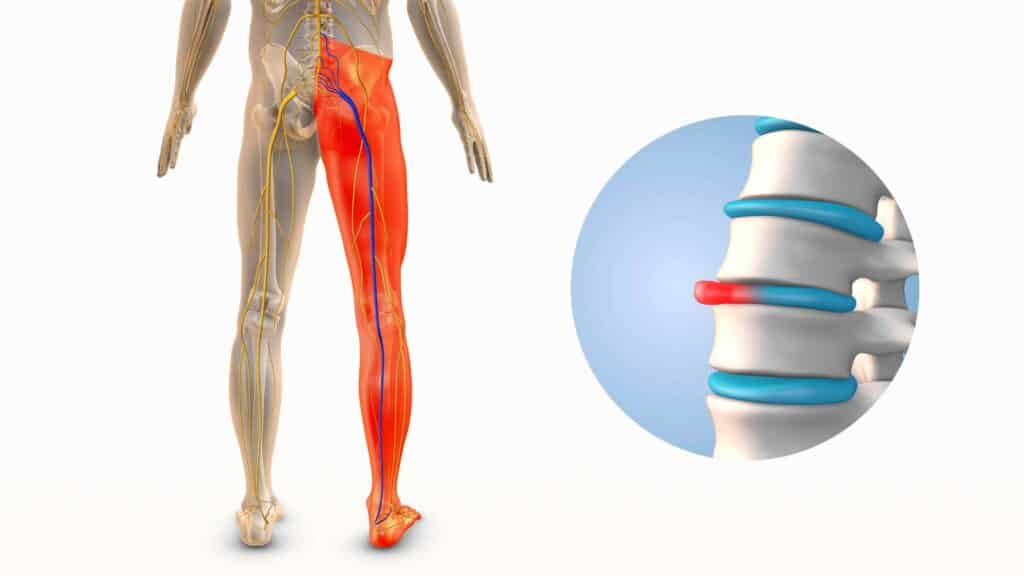 Medical illustration showing a highlighted leg nerve pain pathway and an inset of a herniated spinal disc.